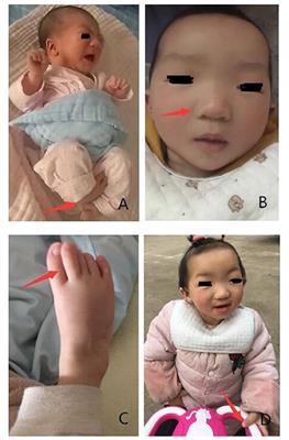 KAT6B Genetic Variant Identified in a Short Stature Chinese Infant: A Report of Physical Growth in Clinical Spectrum of KAT6B-Related Disorders